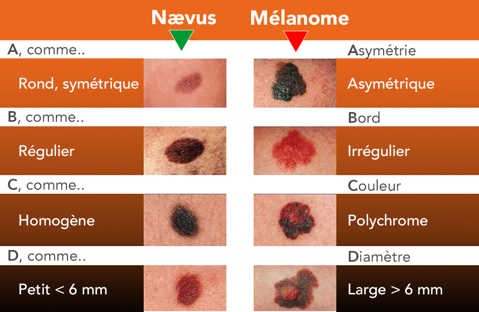 alphabet du melanome