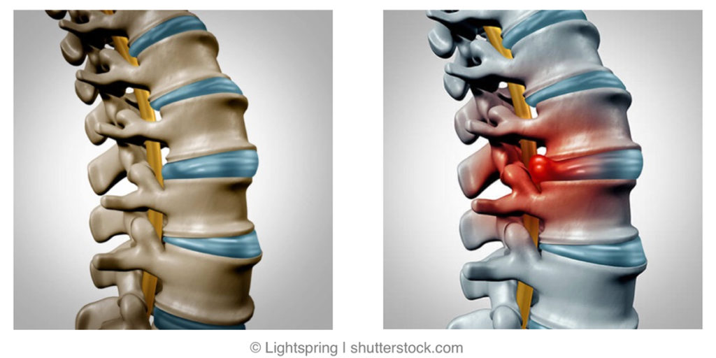Herniated Disc