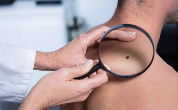 Doctor checking melanoma