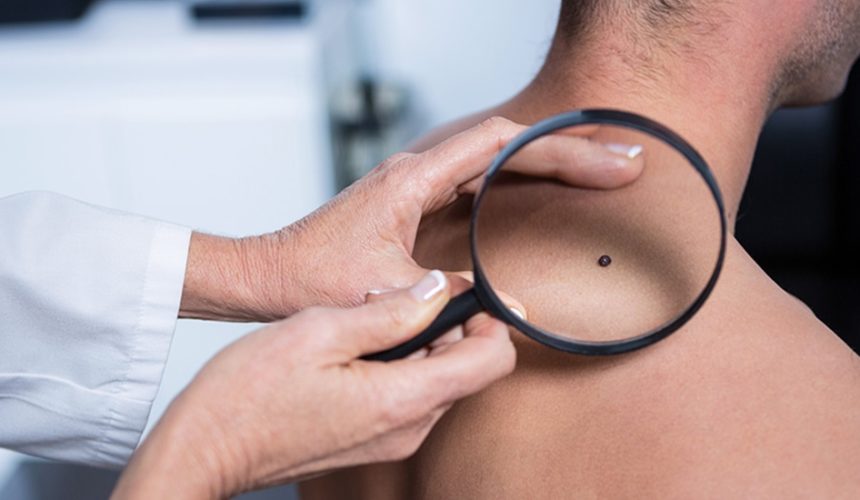 Sun and skin cancer Doctor checking melanoma